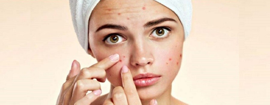 Pro Tips to Combat Acne